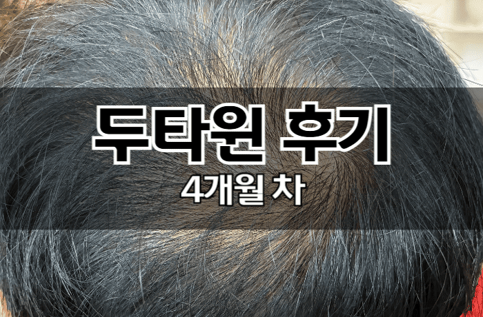 두타윈-후기-정수리-탈모-썸네일